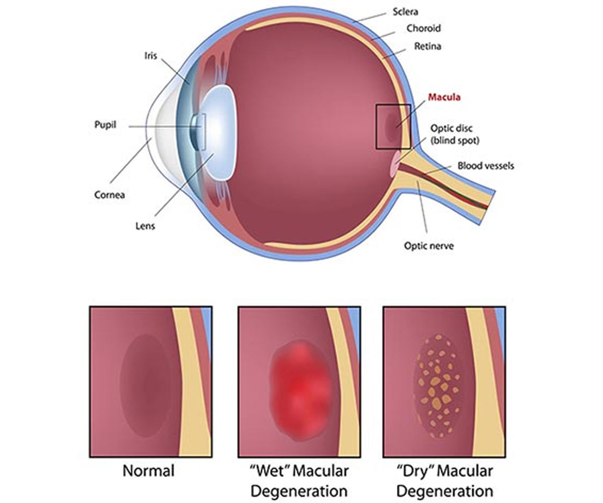 Age related muscular degeneration